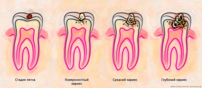 Лечение глубокого кариеса 